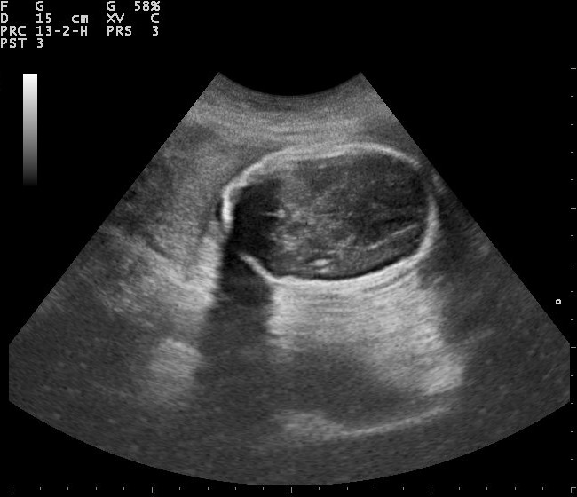 Ultrasound scan showing a fetal skull cross-section